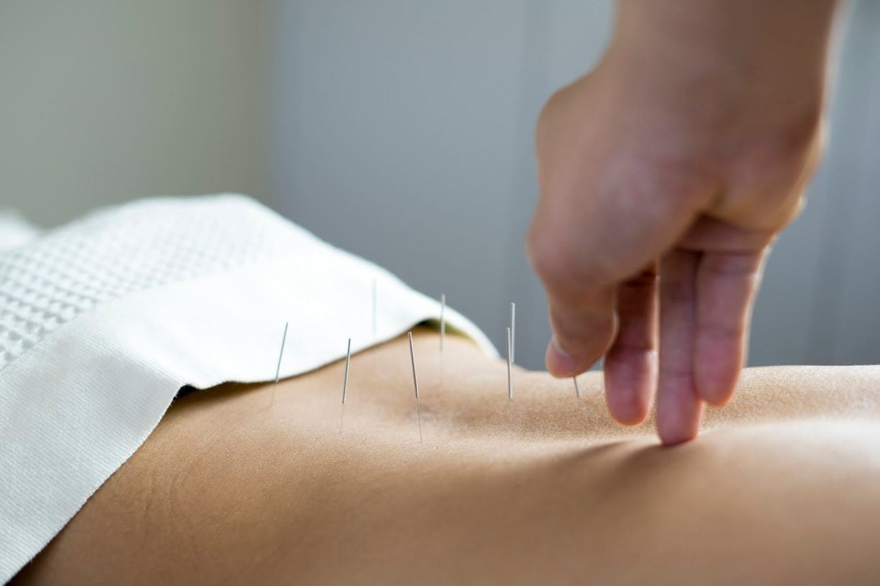 Acupuncture